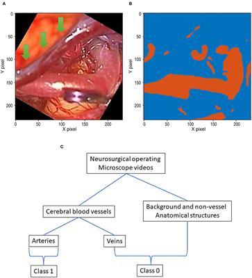 Deep-Learning-Based Cerebral Artery Semantic Segmentation in Neurosurgical Operating Microscope Vision Using Indocyanine Green Fluorescence Videoangiography